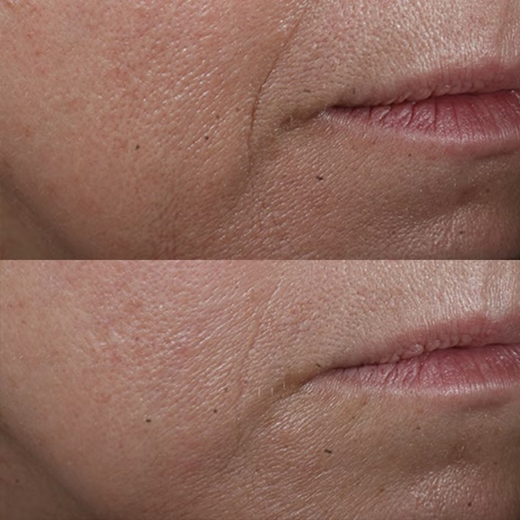 Perricone MD Cold Plasma+ Advanced Serum Concentrate for Youthful & Radiant Skin - Picture 6 of 7